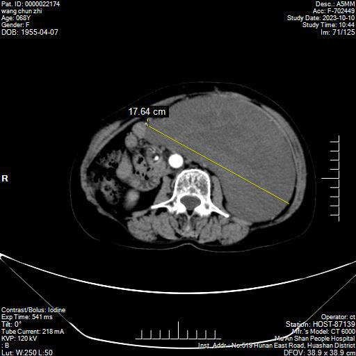 CT檢查影像中黃色線提示腫瘤最長徑.jpg CT檢查影像中黃色線提示腫瘤最長徑.jpg